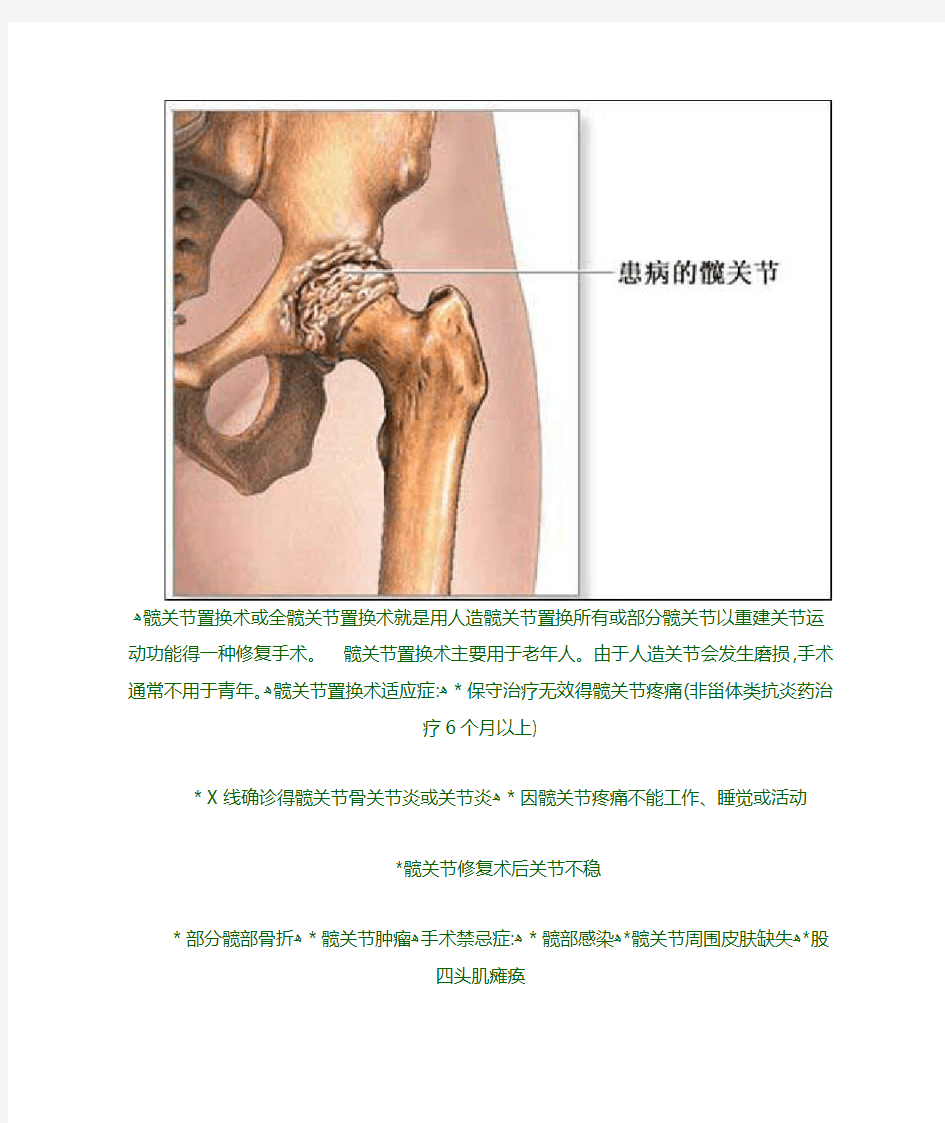 髋关节置换术后护理及康复指导