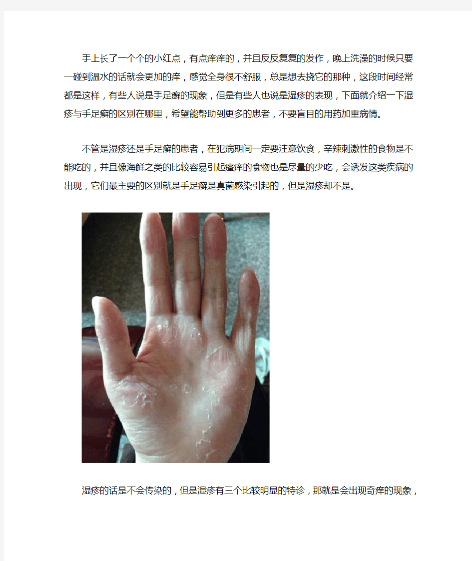 手癣和湿疹的区别