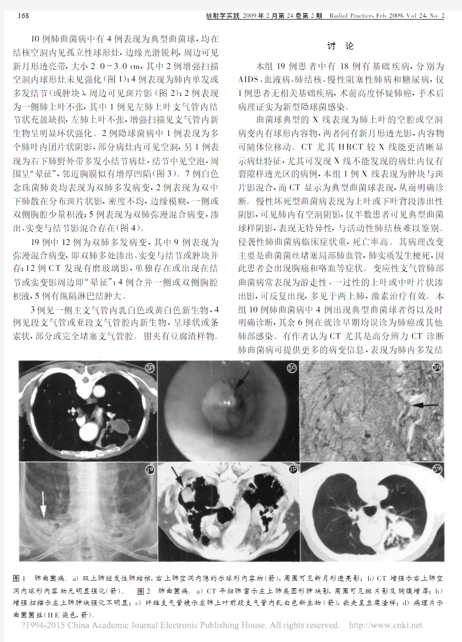 肺真菌病的影像征象分析与诊断_徐丽莹